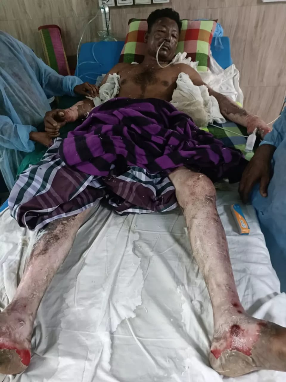 ঢাকার নবাবগঞ্জে বখাটের দেয়া পেট্রোলে দগ্ধ দিনমজুর ৫দিন পর মৃত্যু